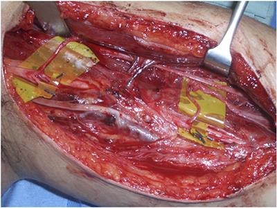 Ulnar and Median Fascicular Transfers for Elbow Flexion-Predicting Outcomes in a Heterogeneous Patient Group and Implications for Surgical Planning